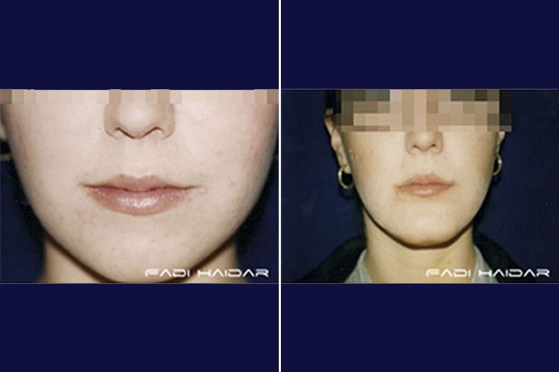 Implantes Faciales