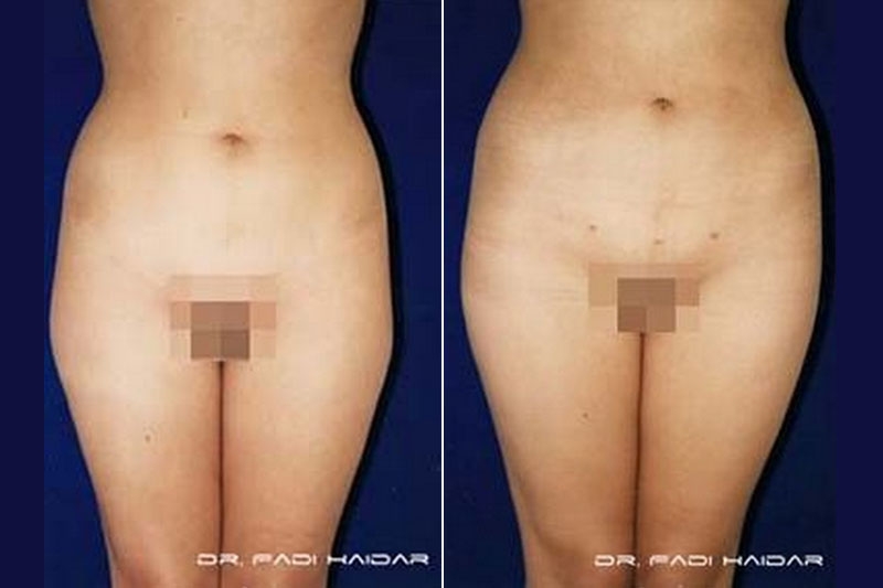 Lipoescultura 3