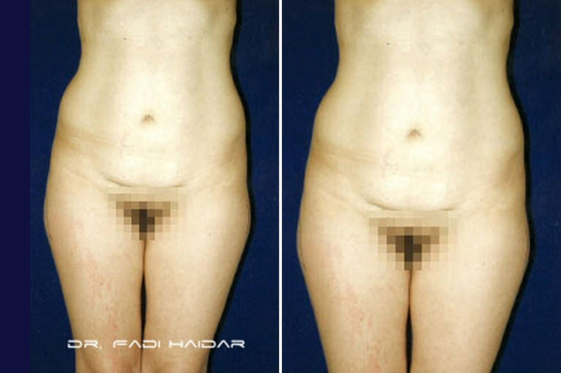 Lipoescultura 7