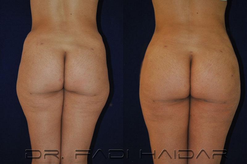 Lipoescultura 11