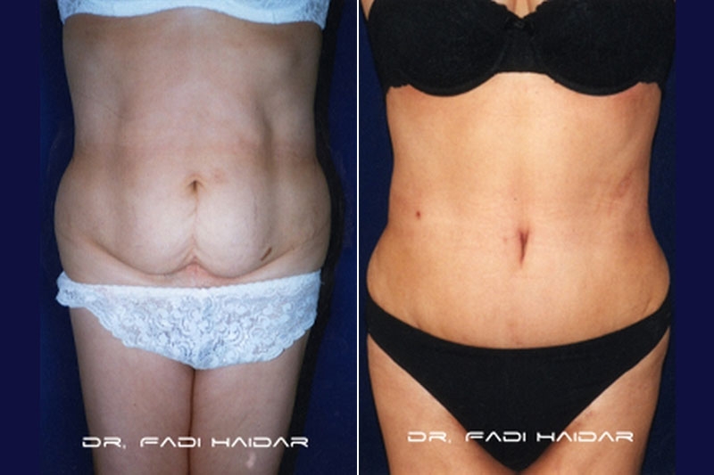 Abdominoplastia Cirugía de Abdomen 1