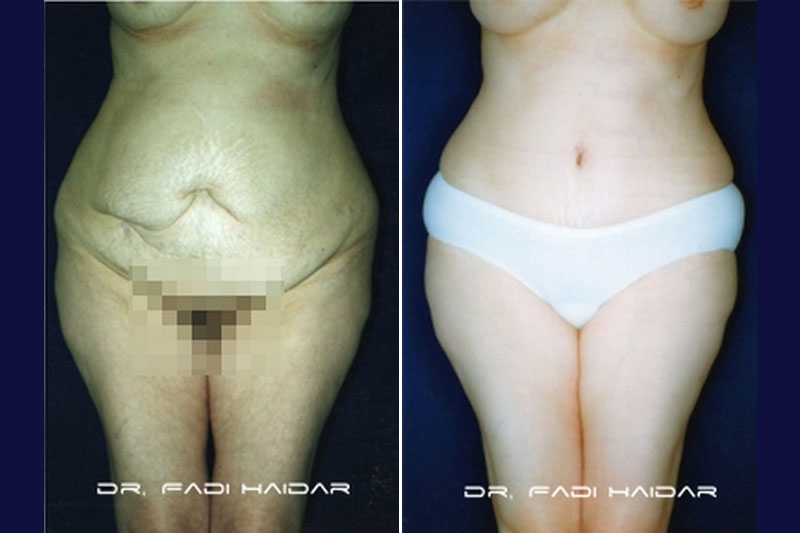 Abdominoplastia Cirugía de Abdomen 2