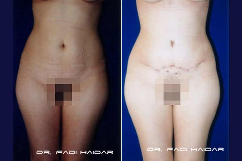 Abdominoplastia Cirugía de Abdomen 4