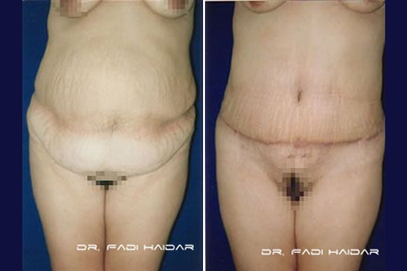 Abdominoplastia Cirugía de Abdomen 5