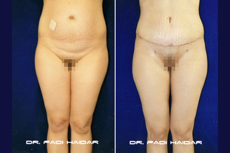 Abdominoplastia Cirugía de Abdomen 7