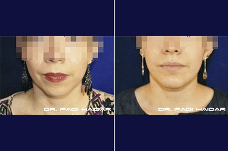 Implantes Faciales 2