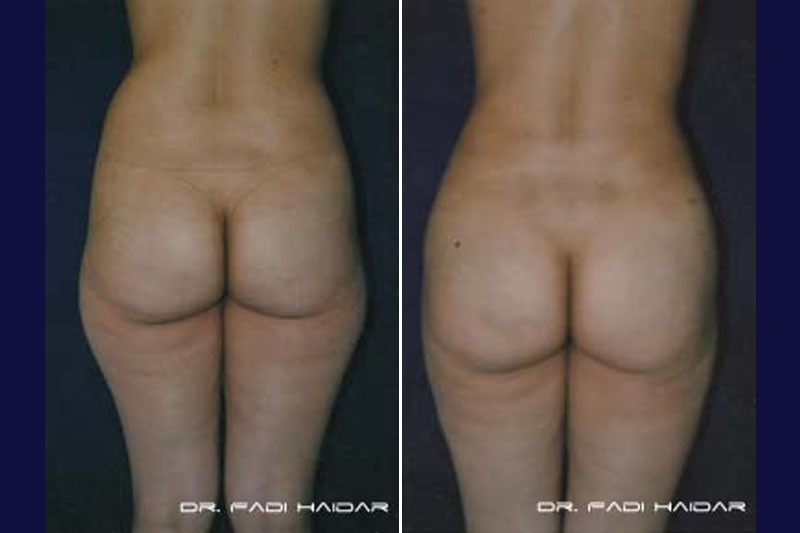 Lipoescultura 8