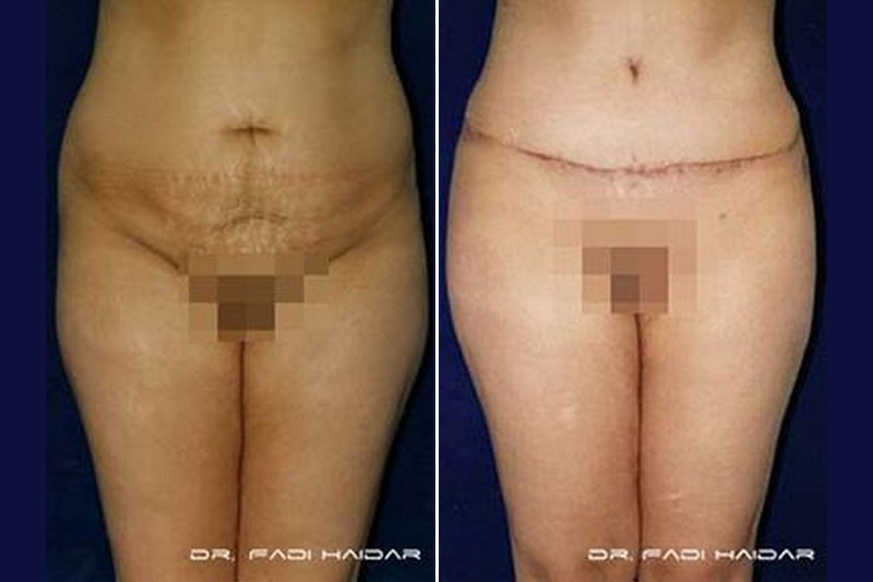 Abdominoplastia Cirugía de Abdomen 6