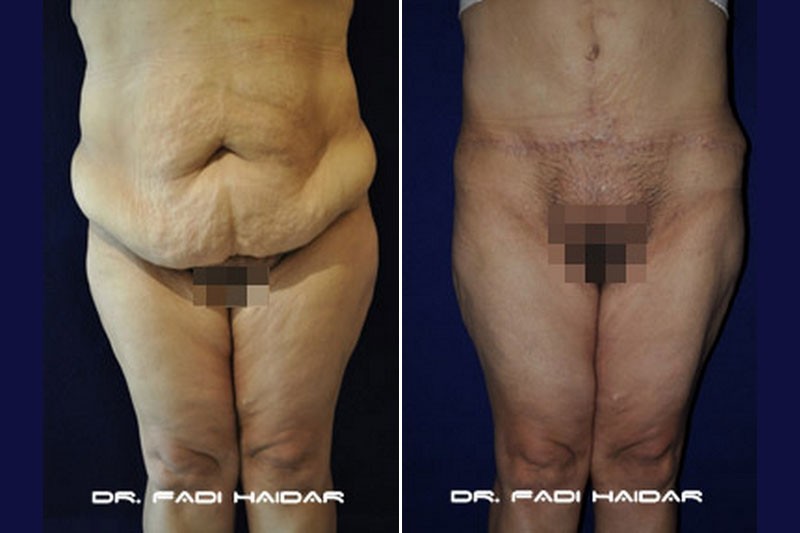 Abdominoplastia Cirugía de Abdomen 9