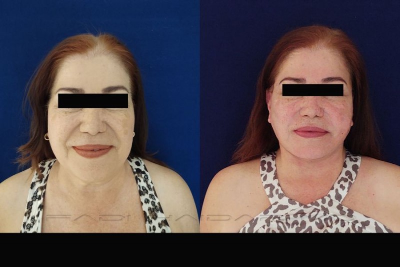 Lifting Facial 13