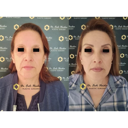 Lifting Facial