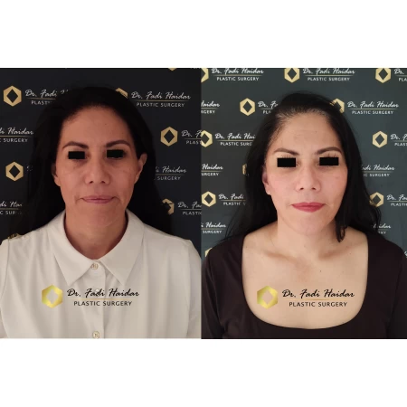 Lifting facial Guadalajara